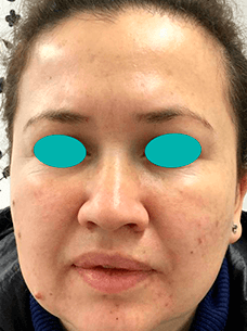 Resultado del tratamiento Bótox Facial